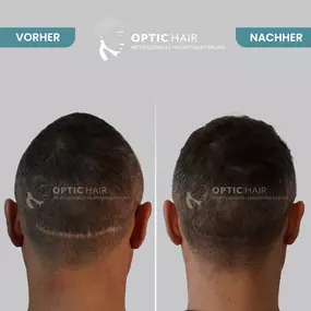 Haarpigmentierung Vorher Nachher Bilder Optic Hair