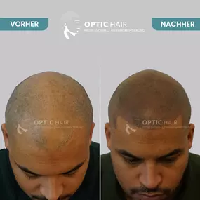 Haarpigmentierung Vorher Nachher Bilder Optic Hair