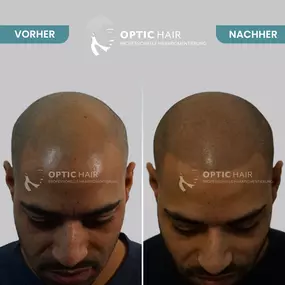 Haarpigmentierung Vorher Nachher Bilder Optic Hair