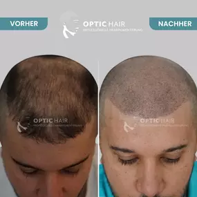 Haarpigmentierung Vorher Nachher Bilder Optic Hair