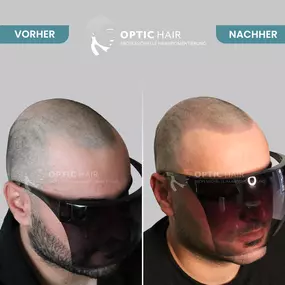 Haarpigmentierung Vorher Nachher Bilder Optic Hair