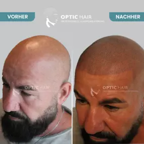 Haarpigmentierung Vorher Nachher Bilder Optic Hair