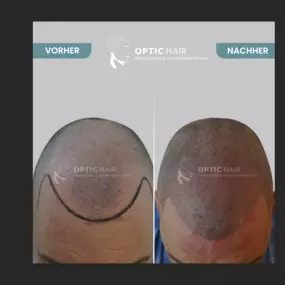 Haarpigmentierung Vorher Nachher Bilder Optic Hair