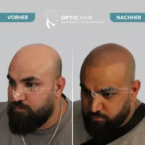 Haarpigmentierung Vorher Nachher Bilder Optic Hair