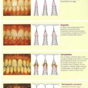 enfermedad-periodontal-05.jpg