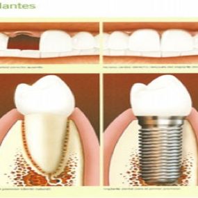 implantes-03.jpg