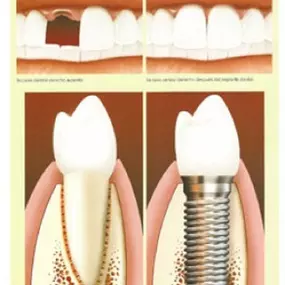 implantes-03.jpg