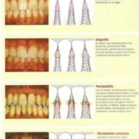 enfermedad-periodontal-05.jpg