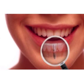 clinica-dental-jose-maria-valdivieso-implantes.png