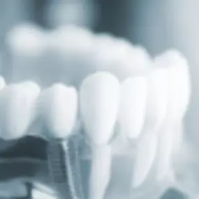 clinica-dental-jose-maria-valdivieso-implantes-dentales.png