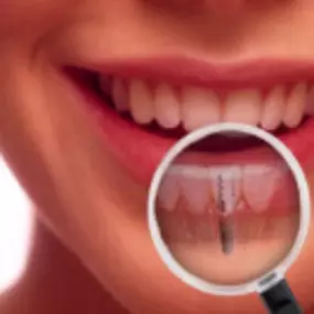 clinica-dental-jose-maria-valdivieso-implantes.png