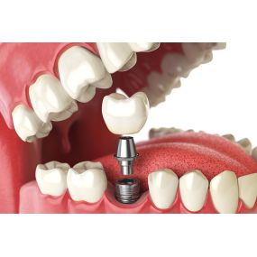 Implantes-dentales.jpg