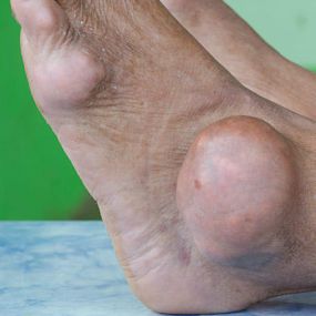 Foot Problems - Gout