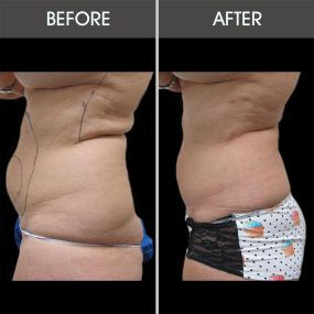 Liposuction in Miami can melt away localized fatty deposits in the arms, abdomen, hips, thighs, knees, back, and chest, helping patients achieve a sculpted physique with no downtime.