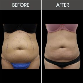 Offering liposuction in Miami, Dr. Selem provides minimally invasive body sculpting to treat troublesome areas of fat, leaving patients with smoother, tighter skin.