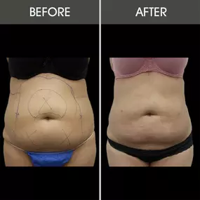 Offering liposuction in Miami, Dr. Selem provides minimally invasive body sculpting to treat troublesome areas of fat, leaving patients with smoother, tighter skin.