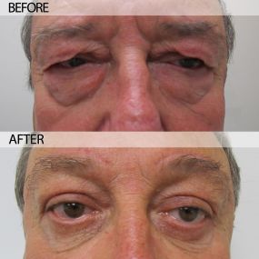 Eyelid surgery in Miami can remove excess sagging skin from the eyelid that typically develops with age. In addition to correcting cosmetic complications of drooping eyelids, functional eyelid surgery can even improve overall vision in more severe cases. Dr. Selem offers eyelid surgery for the upper and lower eyelids to remove excess skin and fat and improve the appearance of the eyes.