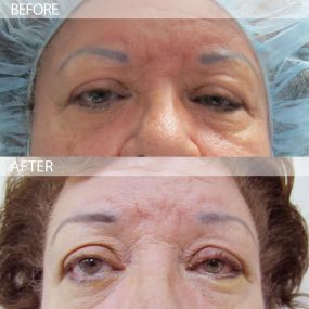 Treating ptosis, which is the drooping of the upper eyelid, is a specialty of Dr. Joseph Selem, our Miami ophthalmologist. Raising the eyelid with upper eye lid correction will help you look younger and can even improve some patients’ vision.