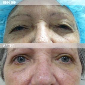 Blepharoplasty surgery can help patients look younger and more alert. This eyelid surgery is able to correct upper eyelid sagging and under eye bags or circles. Our eye surgeon uses careful planning when performing your procedure, placing incisions in an inconspicuous location for discreet healing.