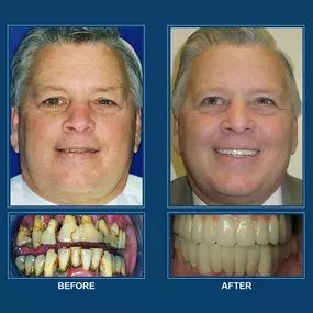 Our oral surgeons provide a number of oral and maxillofacial options, including dental implants, wisdom teeth extraction, and bone grafts. We also offer dental Implants, which are inserted into the jawbone as a prosthetic. After inserting dental implants, a dental crown is then placed for a beautiful, healthy smile. Dental implants are an alternative to dentures, allowing a patient to have teeth that look, feel, and function like natural teeth.