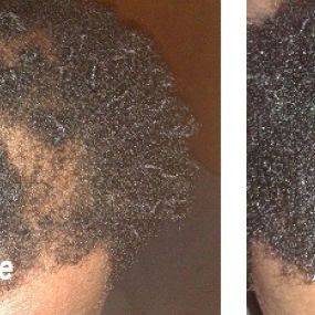 After only 90 days, this client saw substantial hair regrowth.