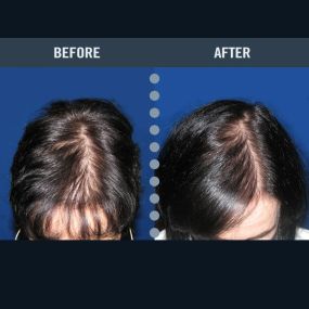 After using laser treatments and HLCC products, this patient had tremendous success in growing back her hair and stopping hair loss.