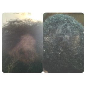 A client with Alopecia Areata stopped her hair loss and re-grew 100% of her hair.