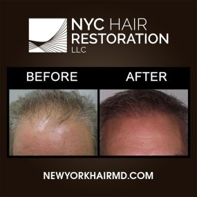 During NeoGraft, hair follicles are extracted and placed using pneumatic pressure, allowing for precise, individualized placement. Our hair surgeon is trained to use a “hands free” technique, meaning the follicles are never touched by hand, resulting in a much more natural-looking transplant than traditional procedures. NeoGraft is a no-stitch, no-scar procedure achieving natural-looking results without a “plug-like” appearance.