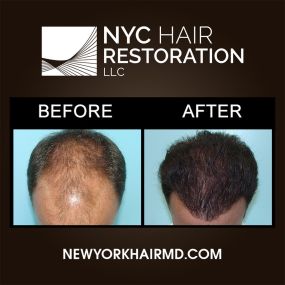 Hair restoration can reverse the signs of aging caused by hair loss giving your hair new life. Dr. Levine has developed a deep understanding of the natural hair shaft angle, allowing him to recreate the natural flow of the scalp. Using the NeoGraft technique, our hair doctor is able to give patients a natural-looking hairline that mimics the direction and placement of your naturally grown follicles.
