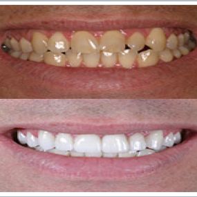 Fairfax Cosmetic Dentistry: Porcelain Veneers Before and After