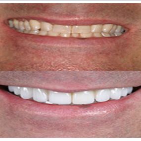 Fairfax Cosmetic Dentistry: Neuromuscular and Full Mouth Rejuvenation Before and After