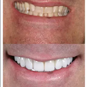 Fairfax Cosmetic Dentistry: Neuromuscular and Full Mouth Rejuvenation Before and After