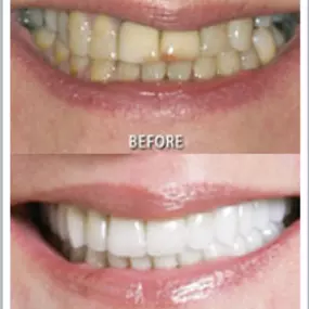 Fairfax Cosmetic Dentistry: Neuromuscular and Full Mouth Rejuvenation Before and After