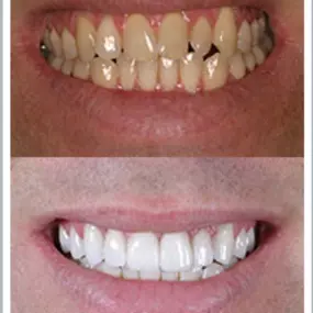 Fairfax Cosmetic Dentistry: Porcelain Veneers Before and After