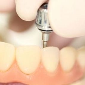 centre-odontologia-miret-puig-implantologia-05.jpg