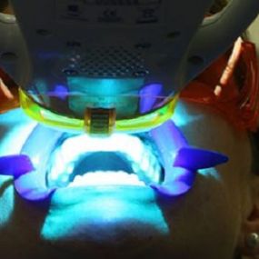 centre-odontologia-miret-puig-blanqueamiento-dental-02.jpg