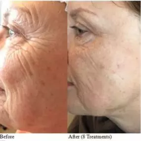 Dermatude The Facelift Alternative