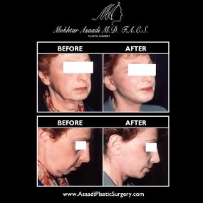 Neck lift surgery can improve the contours of the neck and jawline, improving the definition of the lower face. By removing excess skin and fat, neck lift surgery can provide transformative anti-aging results.