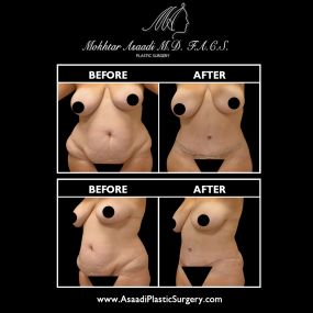 Tummy tuck surgery, or abdominoplasty, is performed to address loose abdominal skin caused by weight fluctuations or pregnancy. Traditional weight loss methods do not treat lax skin. Rather, tummy tuck surgery is designed to remove excess skin and pull the abdominal skin tight, allowing patients to achieve a firmer-looking midsection.