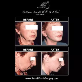 Neck lift surgery can improve the contours of the neck and jawline, improving the definition of the lower face. By removing excess skin and fat, neck lift surgery can provide transformative anti-aging results.