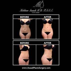 Liposuction can remove stubborn fat that is resistant to routine diet and exercise. Liposuction targets the abdomen, back, arms, thighs, and more. In this case, Dr. Asaadi performed liposuction of the abdomen, flanks, and back. Liposuction is commonly performed with other body contouring procedures to provide comprehensive results.