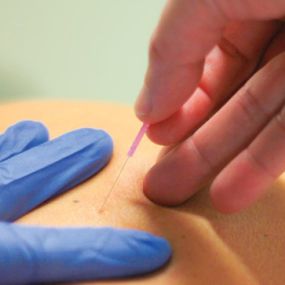 Pijnenburg en Röder Fysiotherapie & Manuele Therapie - Dry Needling