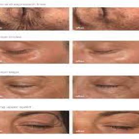 Zie hier de geweldige resultaten van de Periocular peeling van Mesoestetic speciaal voor het gebied rond jouw ogen.