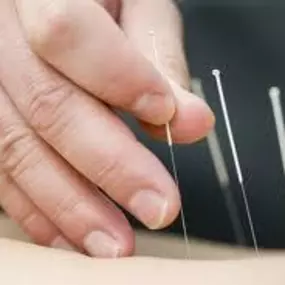 valkfysio_dryneedling_51929dca