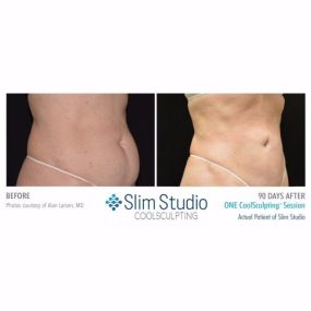 Amazing CoolSculpting Results - Before and After Pics!