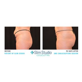 Our Results | Slim Studio Atlanta | Best CoolSculpting Treatment in Atlanta