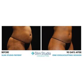 Amazing Ab Results after one CoolSculpting session
