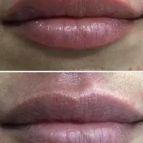 Beautiful, subtle lip filler touch up.