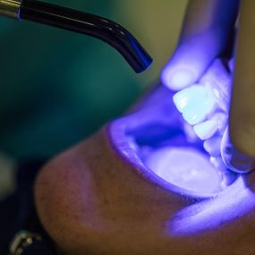 Laser Dentistry Services