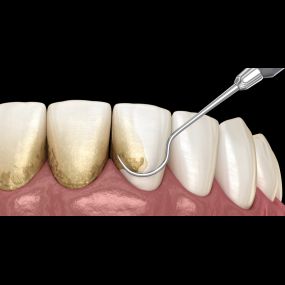 Dental Scaling and Root Planing